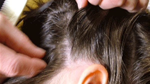 دراسة: مستحضرات علاج ”حشرات الشعر” غير قادرة على مقاومته