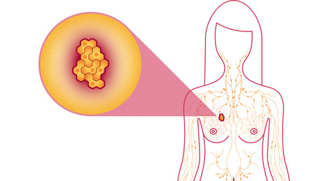 دراسة: فيتامين ”د” يساعد على الشفاء من سرطان الثدي
