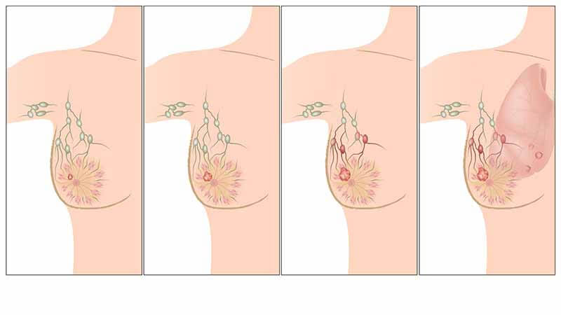 أعراض تشير إلى الإصابة بسرطان الثدي