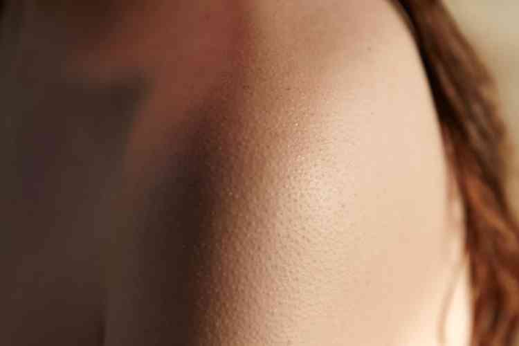 جلد الوزة المزعج.. اعرفي سبب ظهوره وكيفية التعامل معه