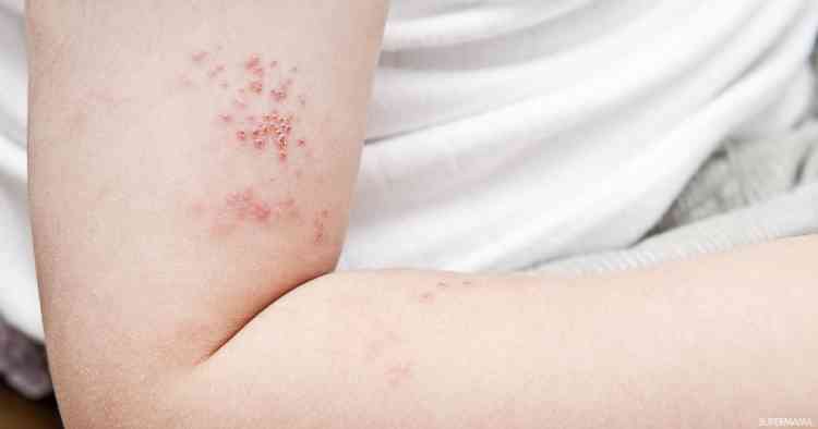 أسباب الحزام الناري وكيف يمكن علاجه أسباب الحزام الناري وكيف يمكن علاجه