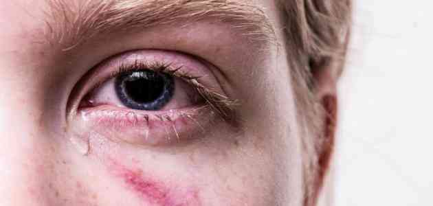 أعراض ارتفاع ضغط العين