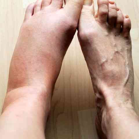 علاج تورم القدمين لمريض السكر