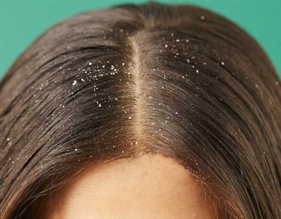 أسباب قشرة الشعر وطرق علاجها